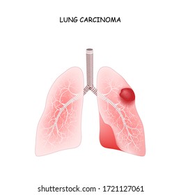 1,315 Malignant lung tumor Images, Stock Photos & Vectors | Shutterstock