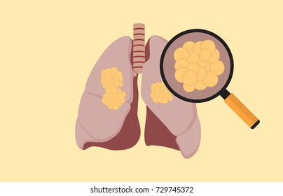 lung cancer with cancer cell on the lung and magnifying glass