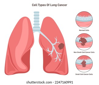 Lung cancer cell types. Pathological malignant cells or tumor located in lung tissue. Pulmonology system disease. Smoking risk. Flat vector illustration