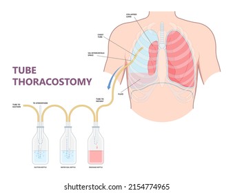 Haemothorax Images, Stock Photos & Vectors 