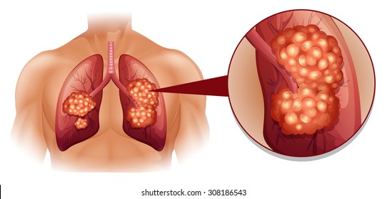 Lung cancer diagram in details illustration