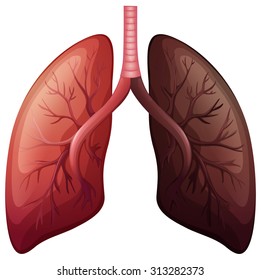 Lung cancer diagram in large scale illustration