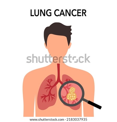 Lung cancer disease concept vector illustration on white background.