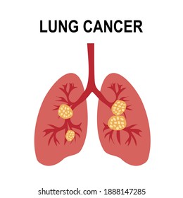 19,355 Lung cancer design Images, Stock Photos & Vectors | Shutterstock