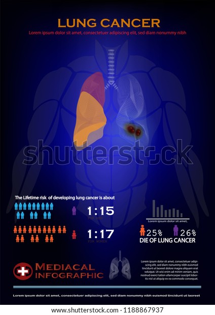 Lung Cancer Infographic Stock Vector (Royalty Free) 1188867937 ...