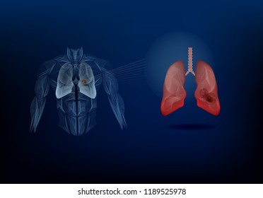 Lung cancer infographic Imformation 