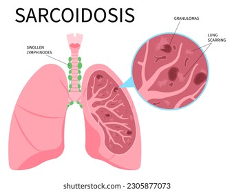 Lung cancer lupus pulmonary fibrosis Sarcoidosis and granuloma amyloidosis tuberculosis of skin eye lymph node uveitis with pernio systemic inflammatory