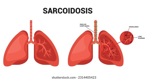 Lung cancer lupus pulmonary fibrosis Sarcoidosis and granuloma amyloidosis tuberculosis