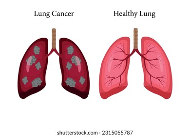 lung cancer and normal lung illustration comparation. eps 10. icon set