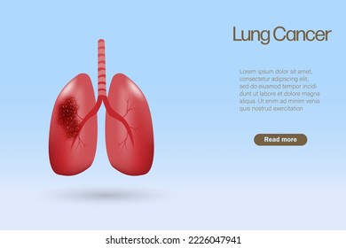 Lung cancer organ with tumor. World cancer awareness. 3D Realistic vector.