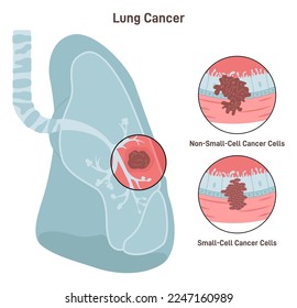 Lung cancer. Pathological malignant cells or tumor located in lung tissue. Pulmonology system disease. Smoking risk. Flat vector illustration