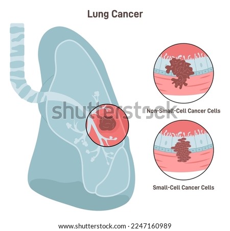 Lung cancer. Pathological malignant cells or tumor located in lung tissue. Pulmonology system disease. Smoking risk. Flat vector illustration