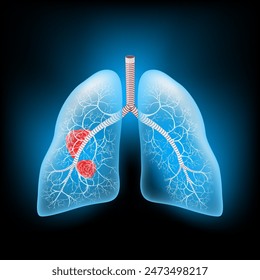 Lung cancer. Realistic transparent blue human lungs with tumor or Metastasis. Glowing effect on dark background. Vector illustration like X-ray image for healthcare design. 