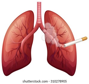 Lung cancer with smoke illustration