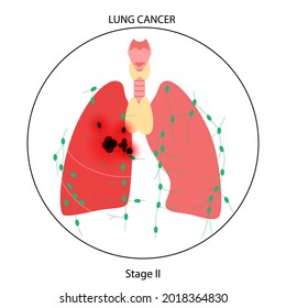 123 Swelling of lymph nodes vector Images, Stock Photos & Vectors ...