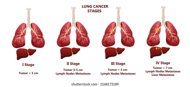 1,893 Lung metastasis Images, Stock Photos & Vectors | Shutterstock