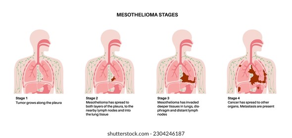 Lung cancer stages, mesothelioma tumor cells spreading. Respiratory system illness. Asbestos related diseases. Shortness of breath, pain in chest, breathing problem, medical flat vector illustration.