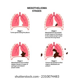 Lung cancer stages, mesothelioma tumor cells spreading. Respiratory system illness. Asbestos related diseases. Shortness of breath, pain in chest, breathing problem, medical flat vector illustration.