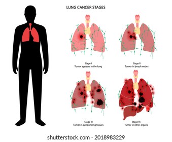 Lung cancer stages. Respiratory system damage, tumor, swelling, inflammation in internal organs and lymph nodes. Human body anatomical poster. Health effect of tobacco smoking flat vector illustration
