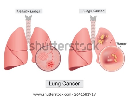 Lung cancer is cancer that forms in tissues of the lung also known as lung carcinoma is a malignant tumor that begins in the lung. Medical healthcare, vector illustration.
