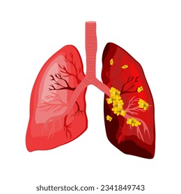 El cáncer de pulmón es un tipo de cáncer que comienza en los pulmones. Sus pulmones son dos órganos esponjosos en el pecho que toman oxígeno cuando inhalan y liberan dióxido de carbono cuando exhalan.