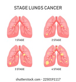 Lung cancer vector concept. Vector illustration.