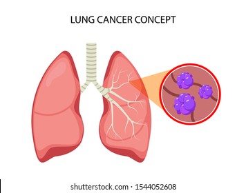 Lung Cancer Vector Concept Repiratory Disease. Cartoon Human Lung Cancer Icon.