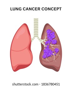 Lung Cancer Vector Concept Respiratory Disease. Cartoon Human Lung Cancer Icon