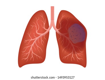 Lung Cell Cancer , Tumor Vector