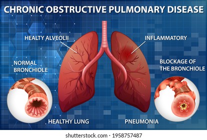 Lung with chronic obstructive pulmonary disease illustration