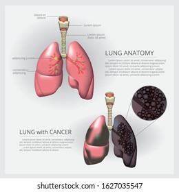 Lung with Detail and Lung Cancer Vector Illustration