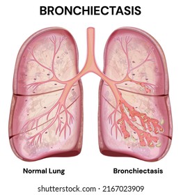 Lung disease. Bronchiectasis labeled diagram. Normal lung and bronchiectasis.Vector medical illustration.