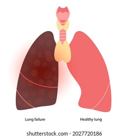 3,527 Lung failure Images, Stock Photos & Vectors | Shutterstock