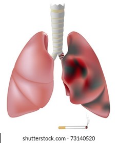 Lung half healthy and half diseased with cancer