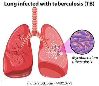 Lung infected with tuberculosis illustration