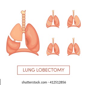 Lung lobectomy - surgical removal of the lobes of the lungs. Set with different lobes needed to be deleted. Simple vector illustration in cartoon style.