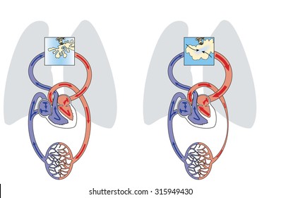 Lung oedema caused by left sided heart failure, resulting in fluid buildup in alveolar spaces.
