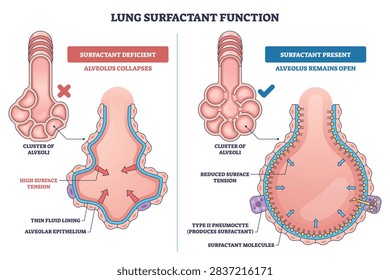 Lung surfactant function illustrated, comparison of open and collapsed alveolus, surfactant molecules and type II pneumocyte reduce surface tension to keep alveoli open, transparent background.