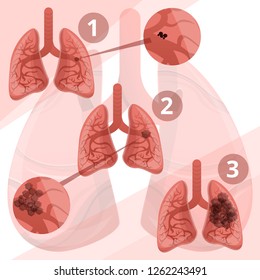 Lung system infographic. Cartoon of lung system vector infographic for web design