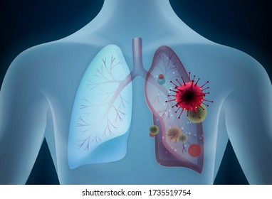 Lungs affected by a COVID-19 vector illustration