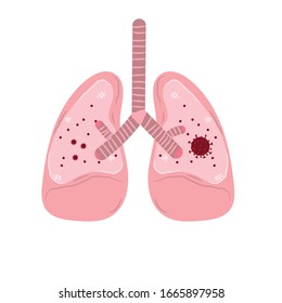 Sick Unhealthy Lungs Tuberculosis Infection Disease Stock Vector ...