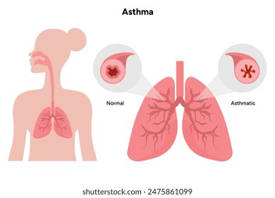 Lungen Asthma in menschlichen Lungen Zoom Medizinisches Diagramm