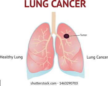 Lungs cancer, lungs disease, isolated vector illustration on White background.