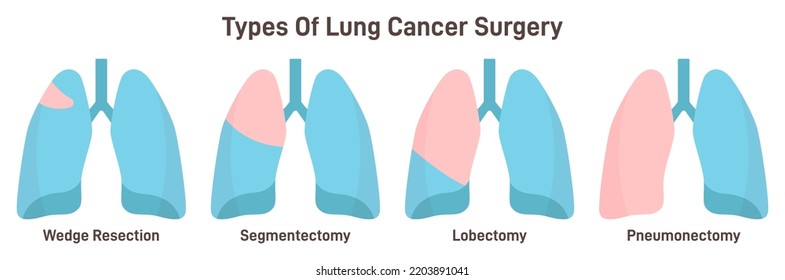 Lungs Cancer Surgery Types. Wedge Resection, Segmentectomy, Lobectomy. Lung Lobes Tumor Removal Surgery. Flat Vector Illustration