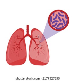 Lungs Of Infected Person. Mycobacterium Tuberculosis Bacteria Danger. Vector Illustration