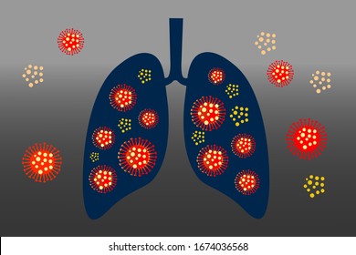 lungs infection coronavirus. Human respiratory virus. influenza virus, respiratory syncytial virus, parainfluenza virus, adenovirus, rhinovirus,coronavirus, dark blue and blur metallic background.