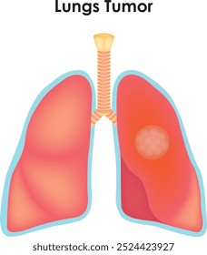 Tumor Do Pulmão Traqueia Lóbulo Superior Lóbulo De Brônquio Lóbulo Inferior Lóbulo Médio Lóbulo Esquerdo E Direito