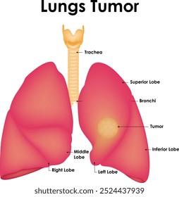 Tumor Do Pulmão Traqueia Lóbulo Superior Lóbulo De Brônquio Lóbulo Inferior Lóbulo Médio Lóbulo Esquerdo E Direito 