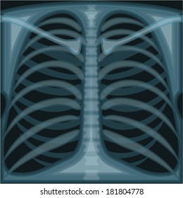 Lungs X Ray