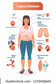 Lupus Disease Vector Illustration. Labeled Diagram With Sickness Symptoms, Like Hair Loss, High Blood Pressure, Muscle Or Joints Pain And Butterfly Rash Red Patches.